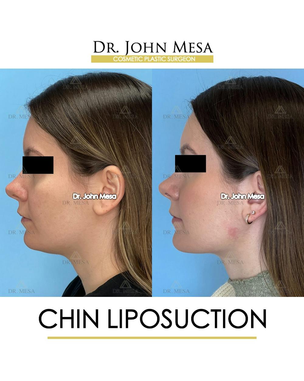 Chin Liposuction Before & After Gallery - Patient 149097966 - Image 5