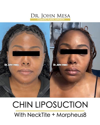 Chin Liposuction Before & After Gallery - Patient 149097972 - Image 1