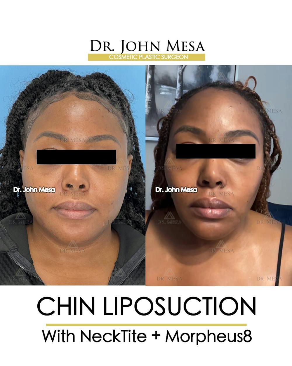 Chin Liposuction Before & After Gallery - Patient 149097972 - Image 1
