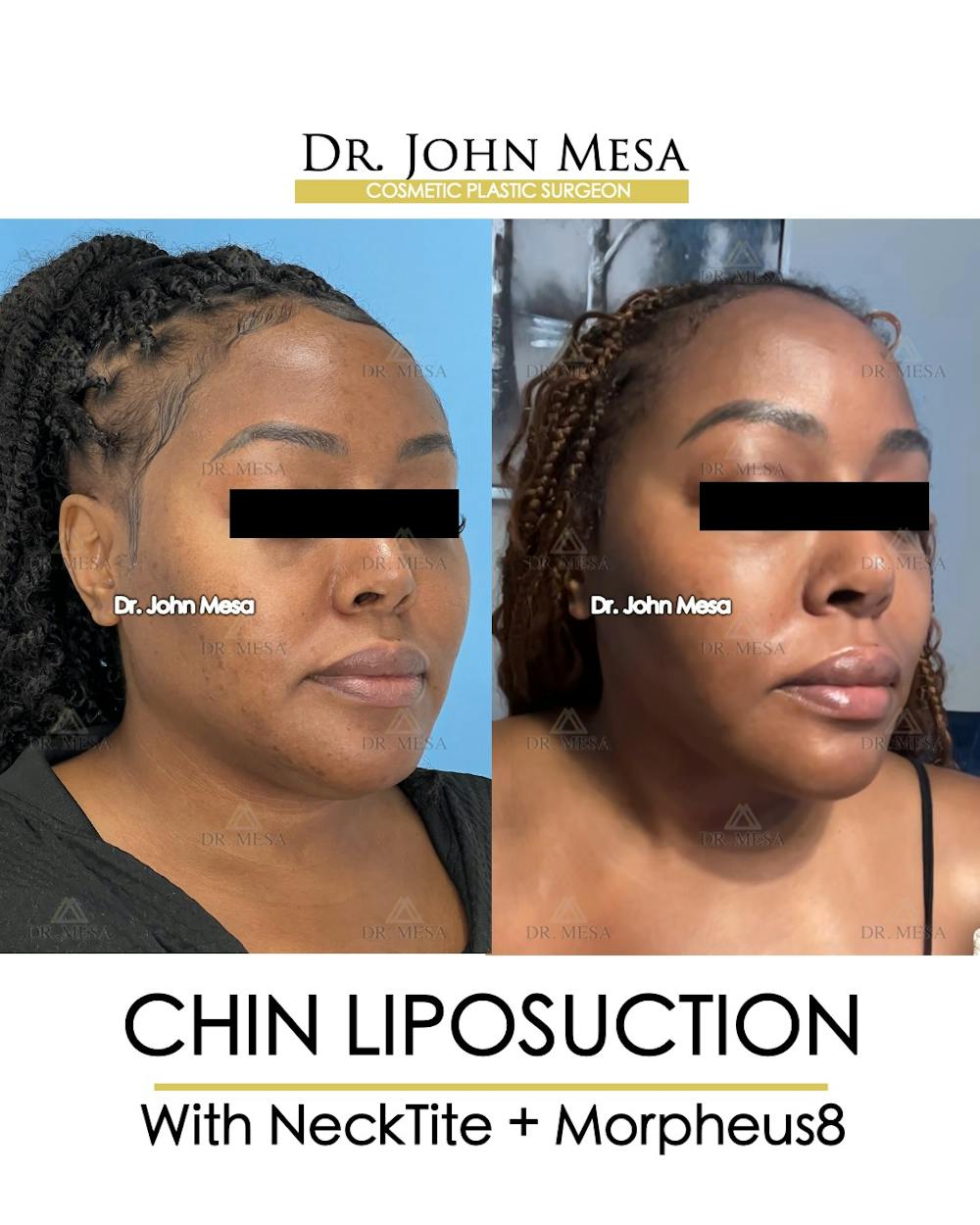 Chin Liposuction Before & After Gallery - Patient 149097972 - Image 2