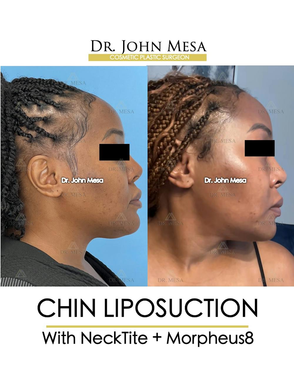 Chin Liposuction Before & After Gallery - Patient 149097972 - Image 3