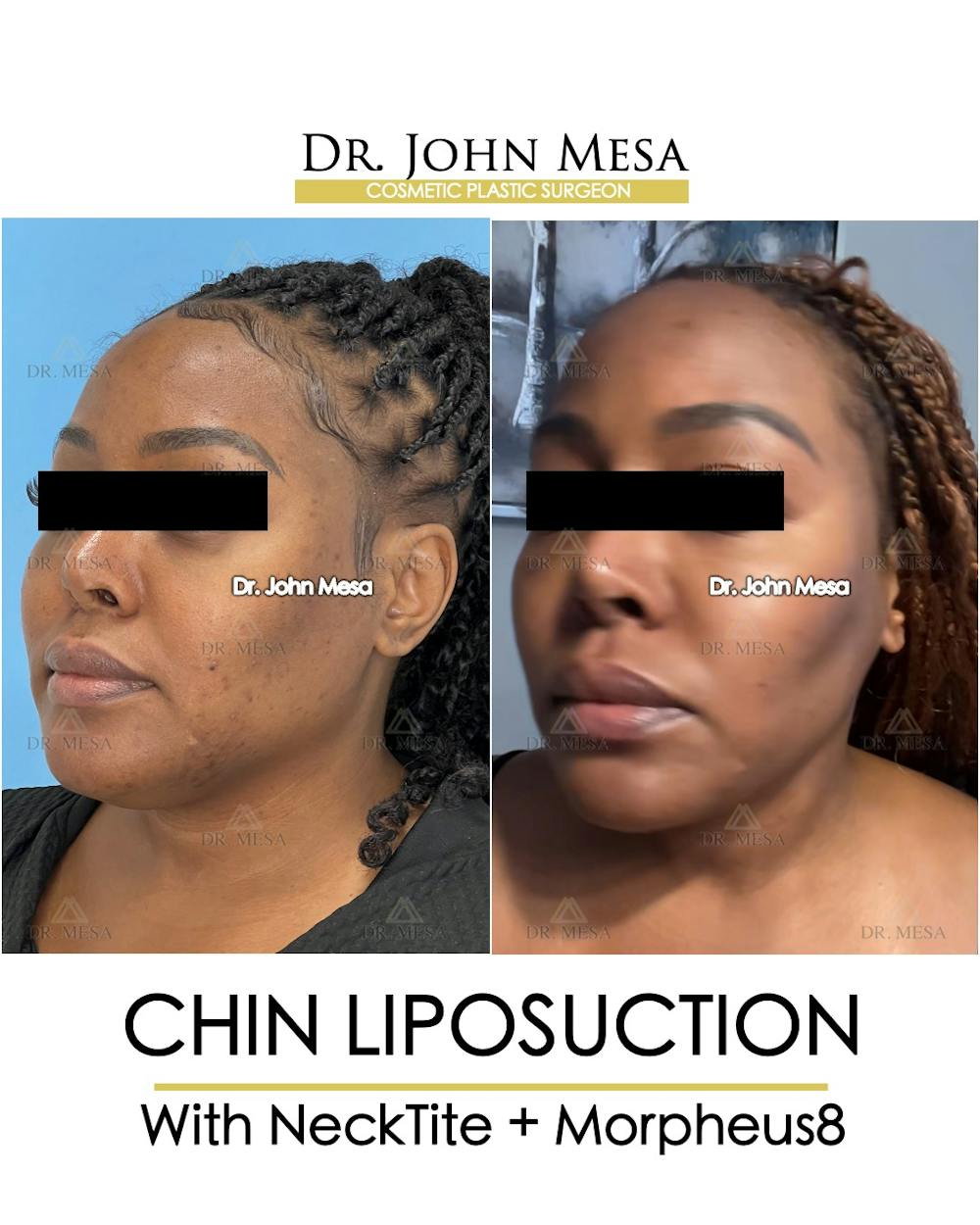 Chin Liposuction Before & After Gallery - Patient 149097972 - Image 4