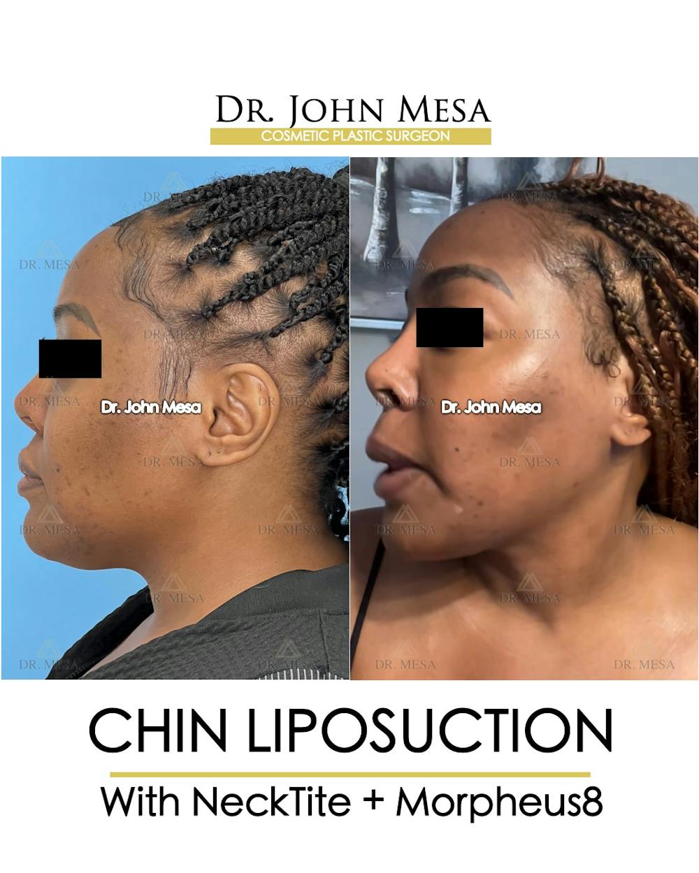 Chin Liposuction Before & After Gallery - Patient 149097972 - Image 5