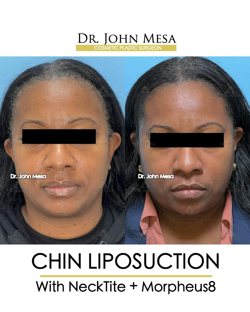 Chin Liposuction Before & After Gallery - Patient 149097976 - Image 2