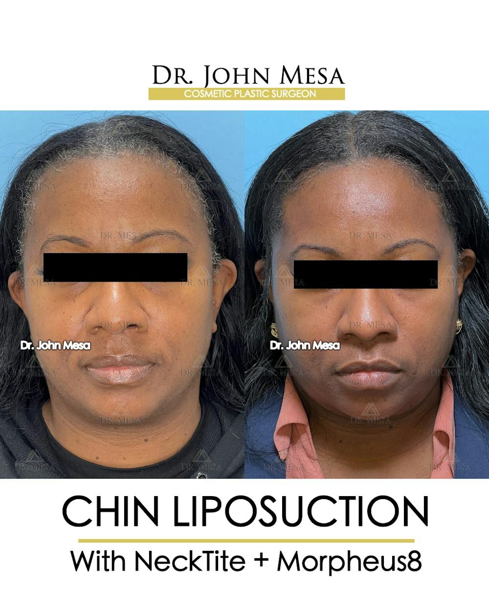 Chin Liposuction Before & After Gallery - Patient 149097976 - Image 1