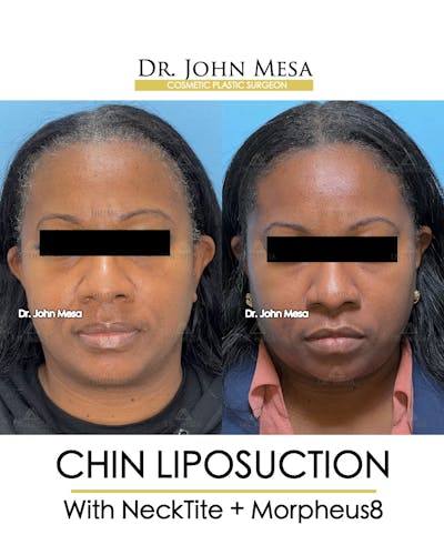 Chin Liposuction Before & After Gallery - Patient 149097976 - Image 1