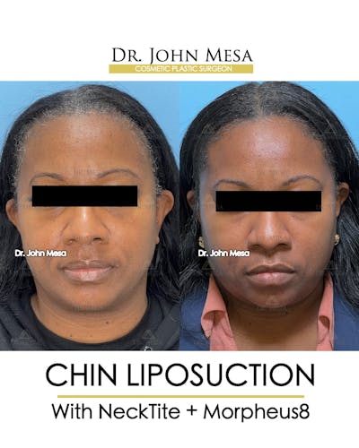 Chin Liposuction Before & After Gallery - Patient 149097976 - Image 2