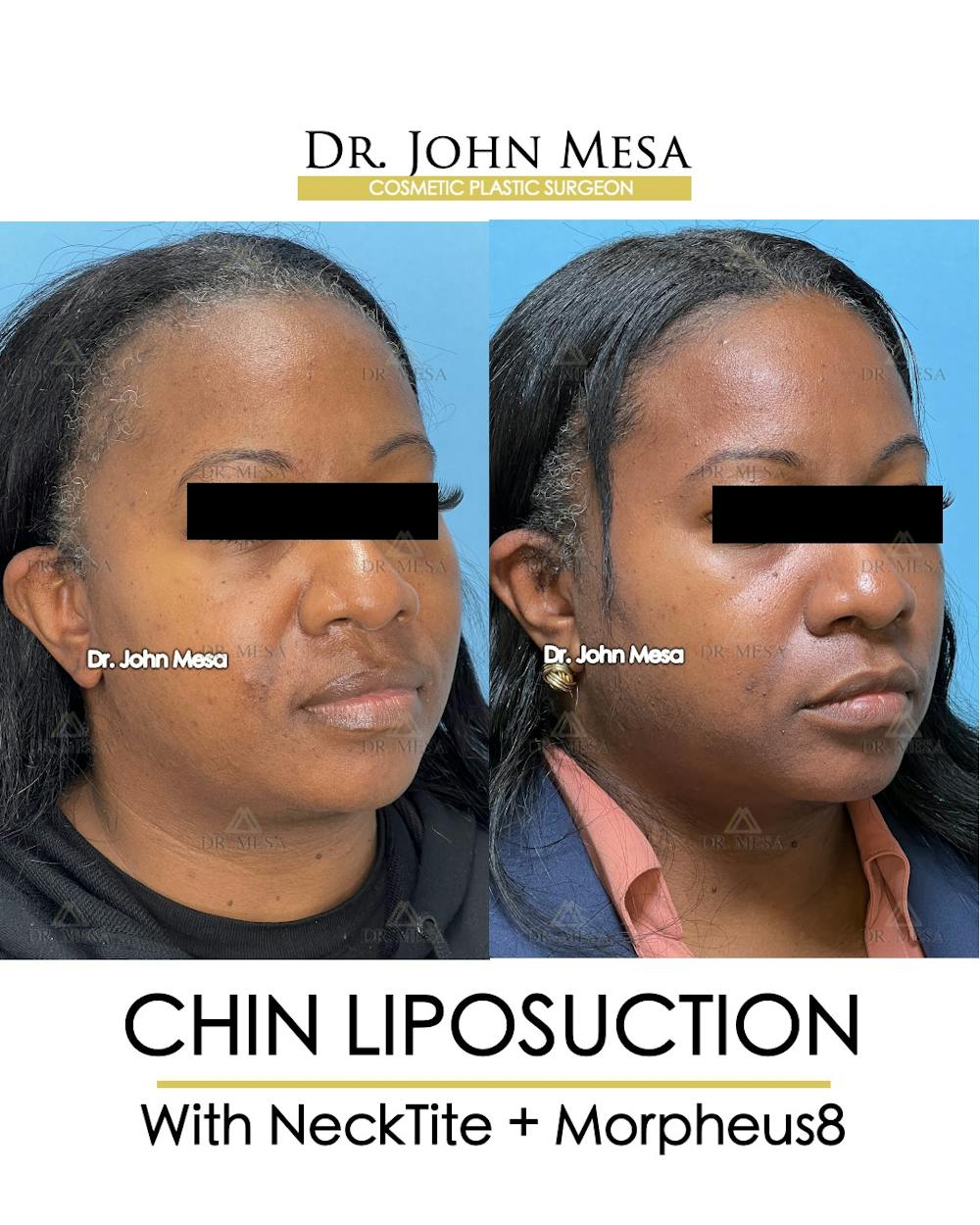 Chin Liposuction Before & After Gallery - Patient 149097976 - Image 3