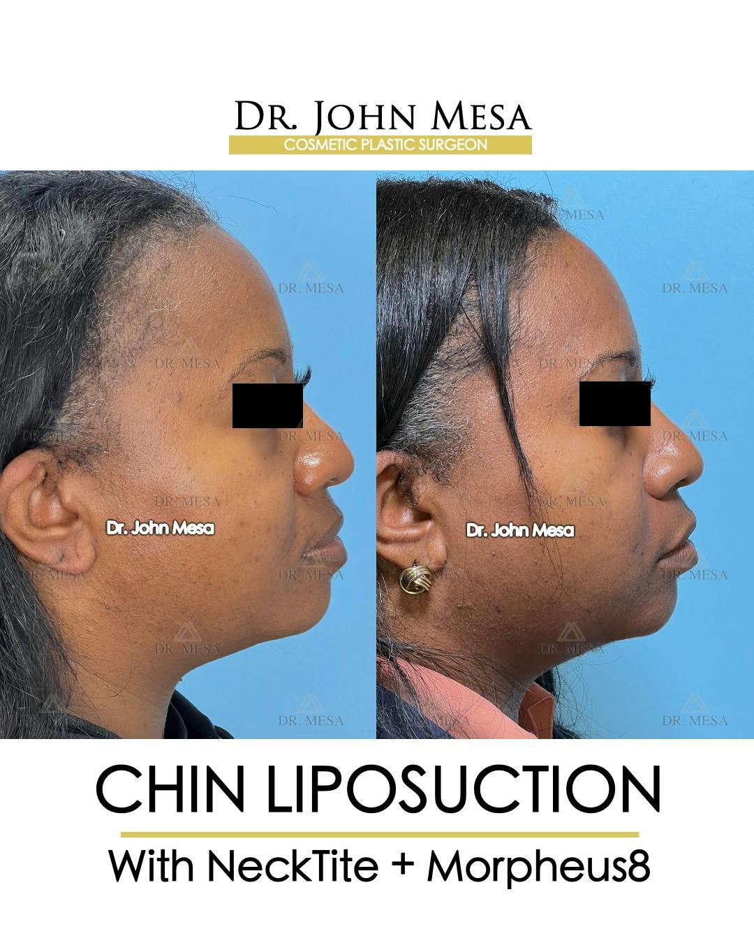 Chin Liposuction Before & After Gallery - Patient 149097976 - Image 1