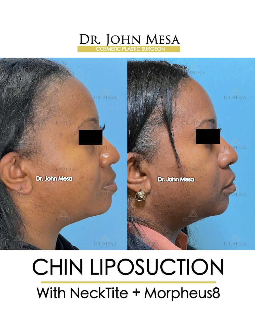 Chin Liposuction Before & After Gallery - Patient 149097976 - Image 3