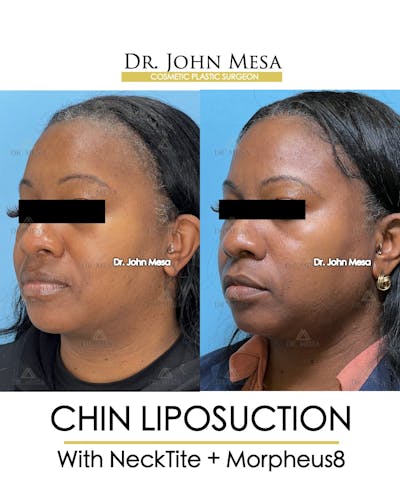 Chin Liposuction Before & After Gallery - Patient 149097976 - Image 4