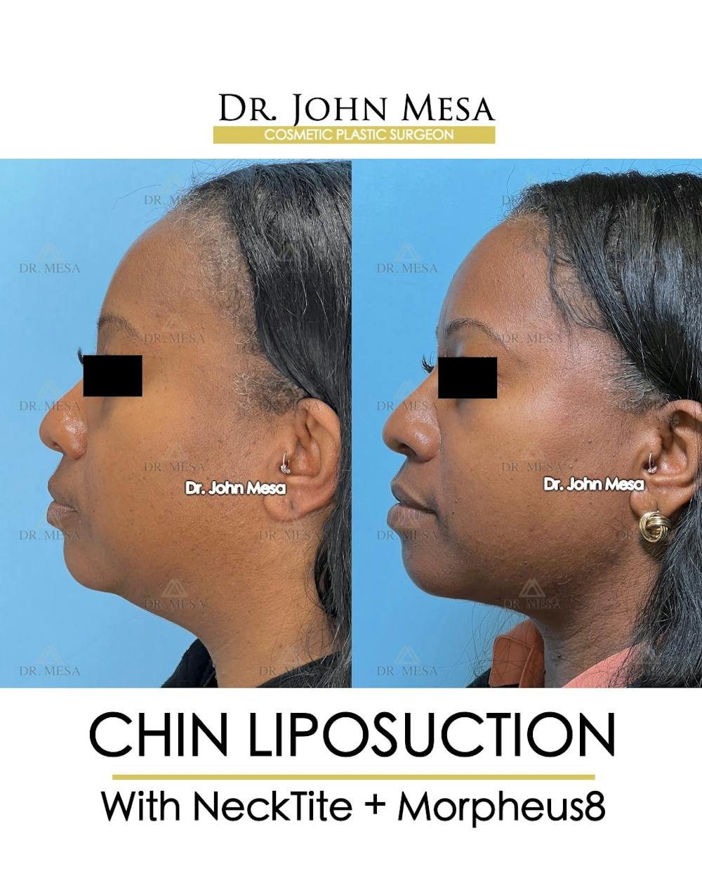Chin Liposuction Before & After Gallery - Patient 149097976 - Image 5