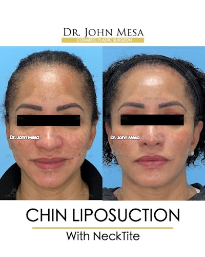 Chin Liposuction Before & After Gallery - Patient 149097977 - Image 1