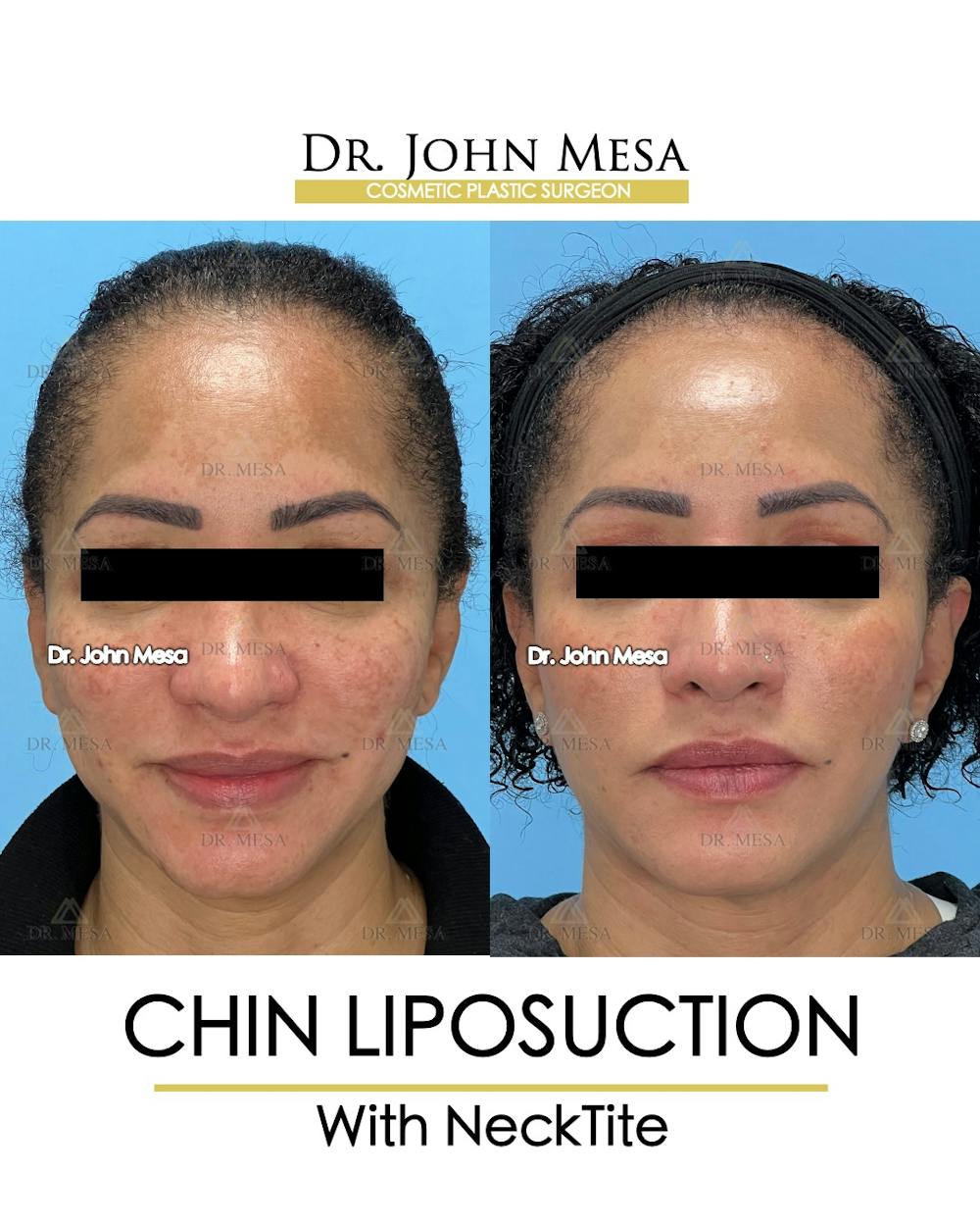 Chin Liposuction Before & After Gallery - Patient 149097977 - Image 2