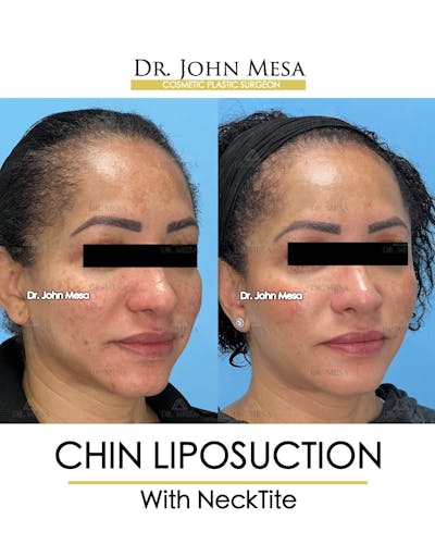NeckTite Before & After Gallery - Patient 149098026 - Image 2