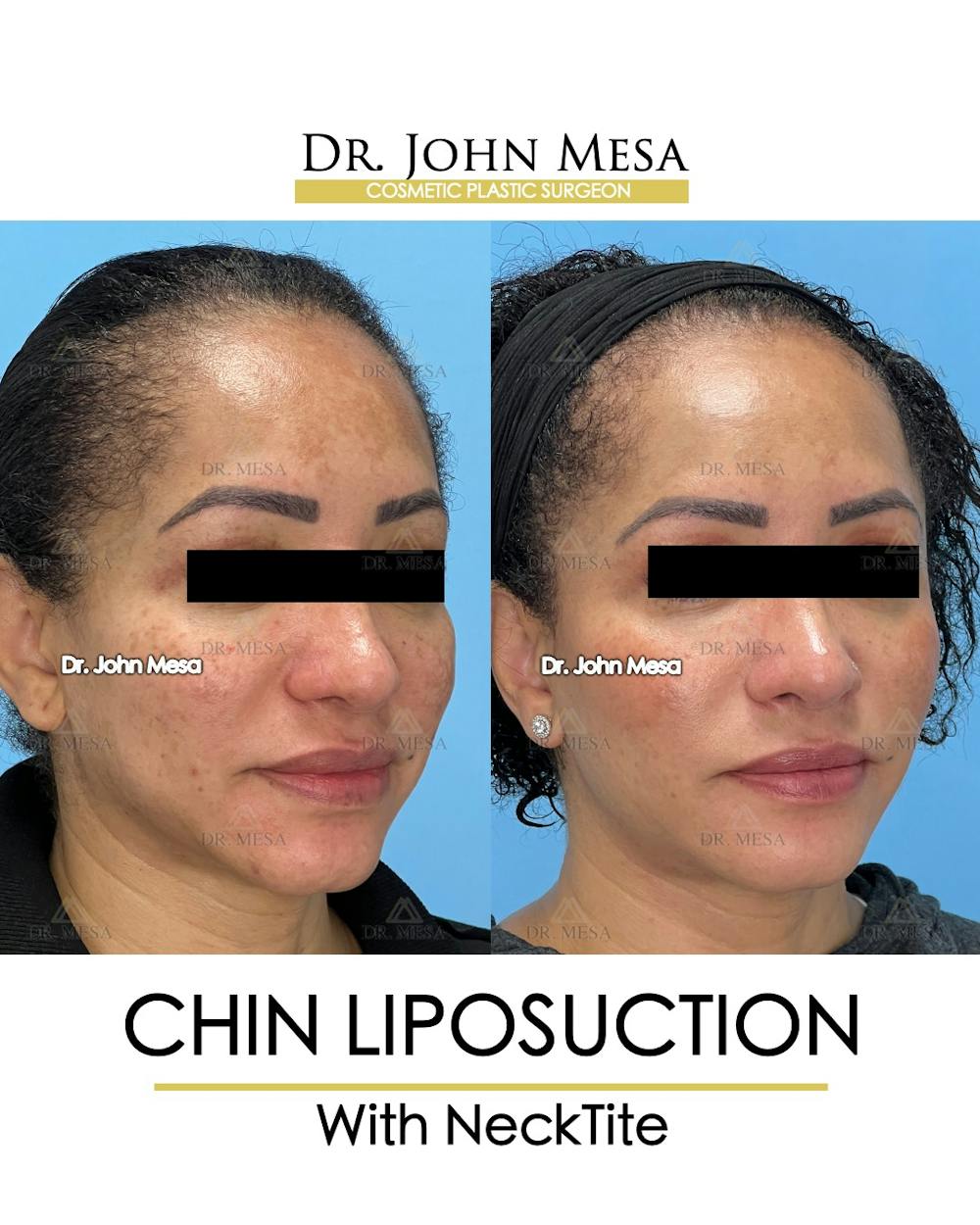 Chin Liposuction Before & After Gallery - Patient 149097977 - Image 3