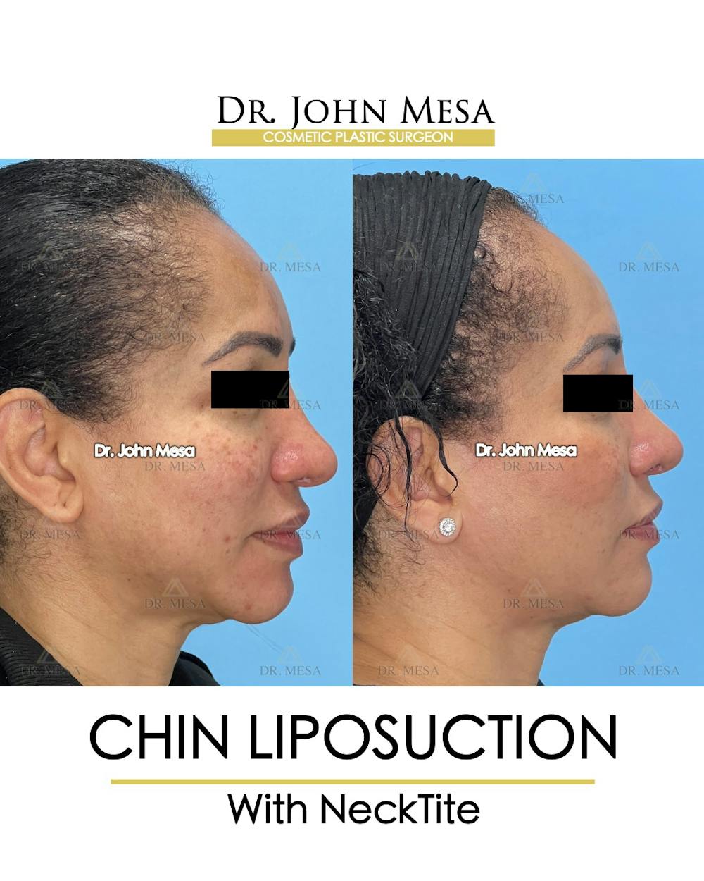 Chin Liposuction Before & After Gallery - Patient 149097977 - Image 3