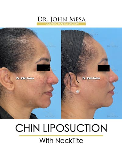 Chin Liposuction Before & After Gallery - Patient 149097977 - Image 1