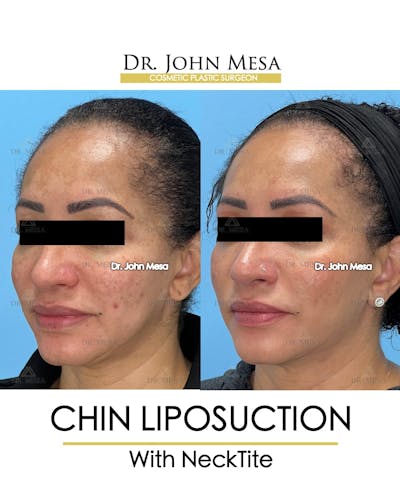 Chin Liposuction Before & After Gallery - Patient 149097977 - Image 4