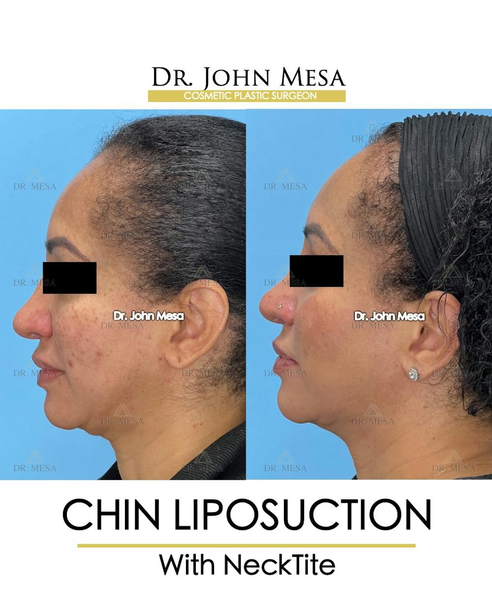 Chin Liposuction Before & After Gallery - Patient 149097977 - Image 5