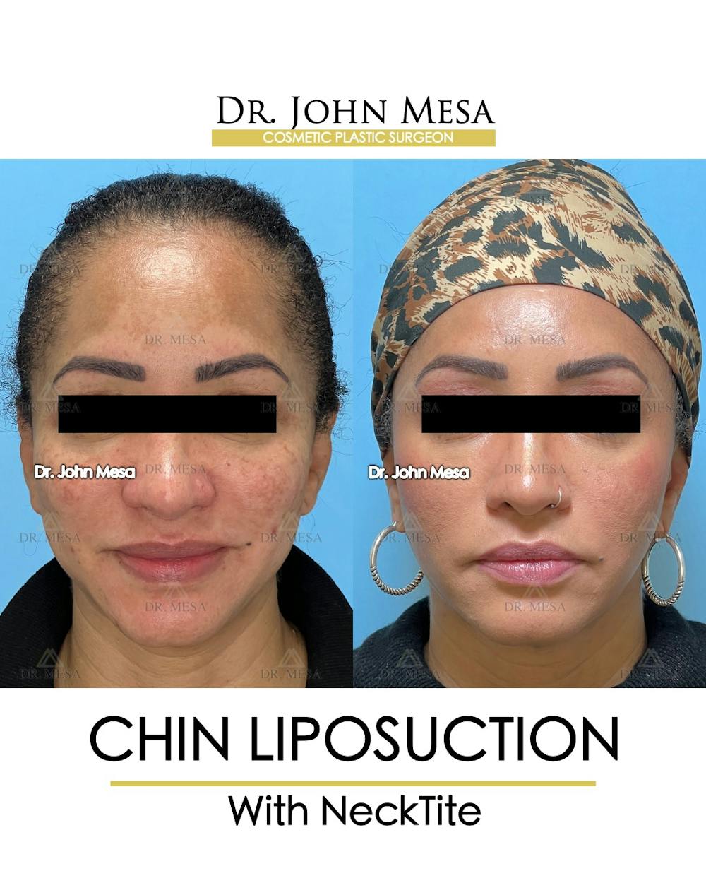 Chin Liposuction Before & After Gallery - Patient 149097983 - Image 1