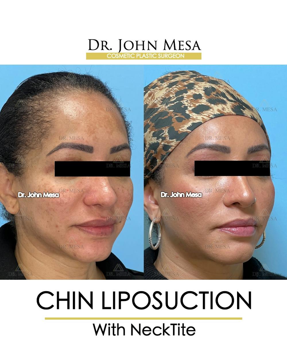 Chin Liposuction Before & After Gallery - Patient 149097983 - Image 3