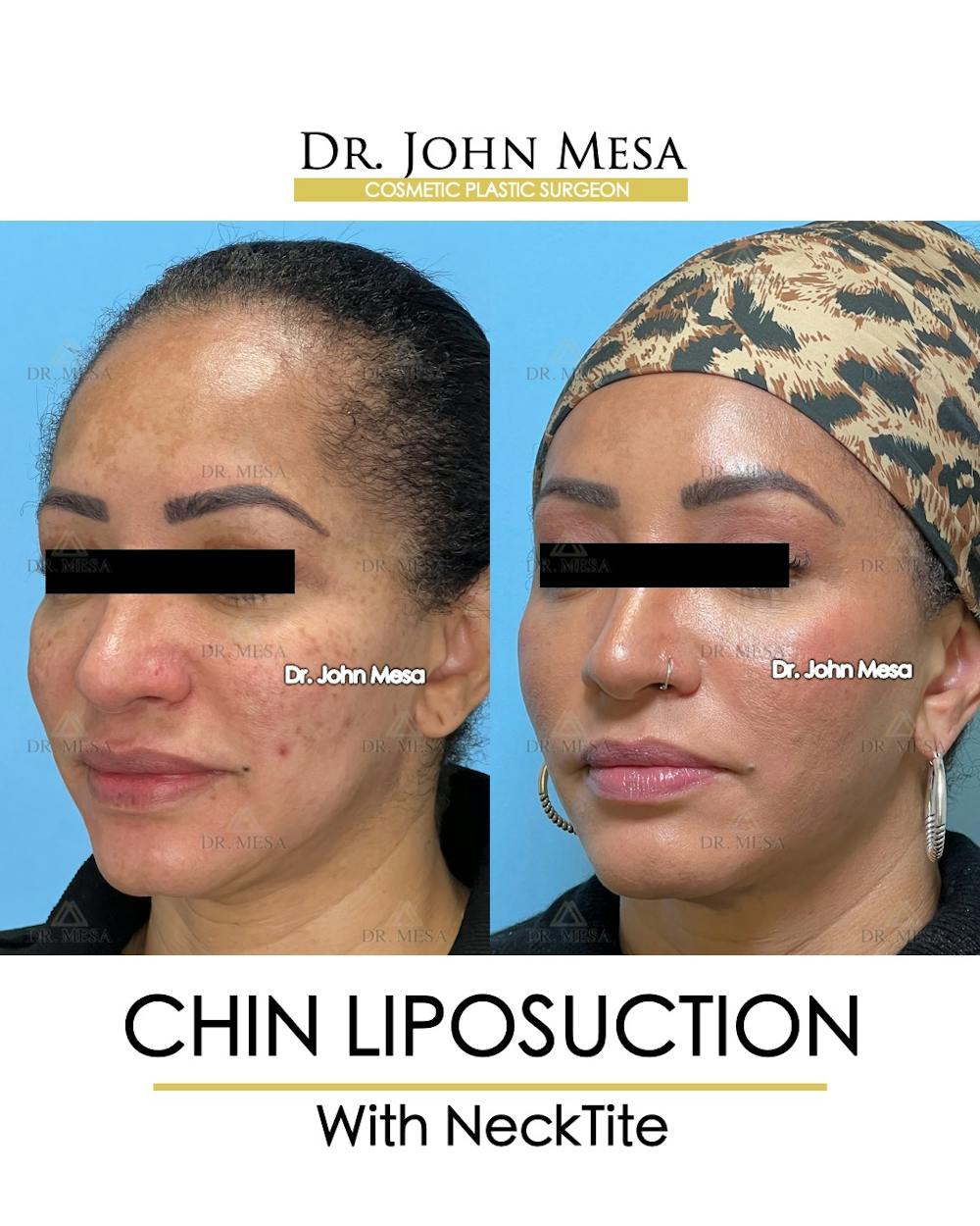 Chin Liposuction Before & After Gallery - Patient 149097983 - Image 4