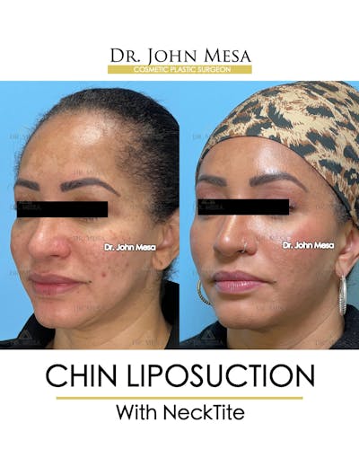 Chin Liposuction Before & After Gallery - Patient 149097983 - Image 4