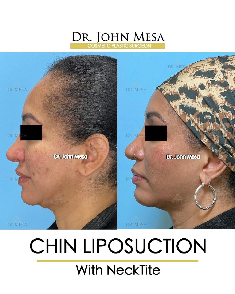 Chin Liposuction Before & After Gallery - Patient 149097983 - Image 5