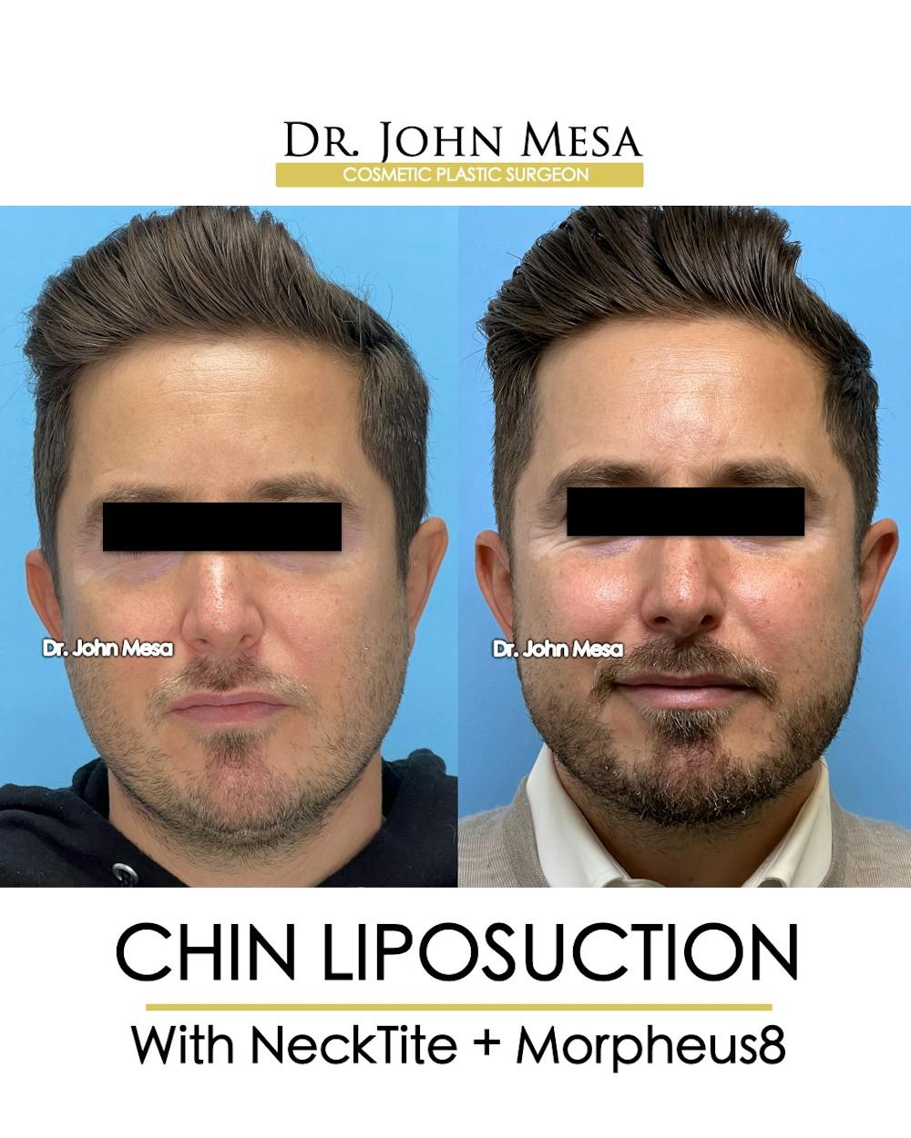 Chin Liposuction Before & After Gallery - Patient 149097987 - Image 2