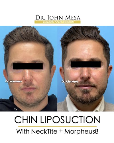 Chin Liposuction Before & After Gallery - Patient 149097987 - Image 1