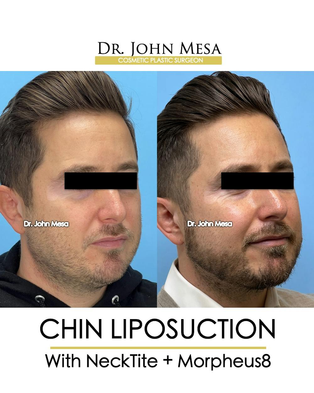 Chin Liposuction Before & After Gallery - Patient 149097987 - Image 3