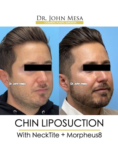 Chin Liposuction Before & After Gallery - Patient 149097987 - Image 2