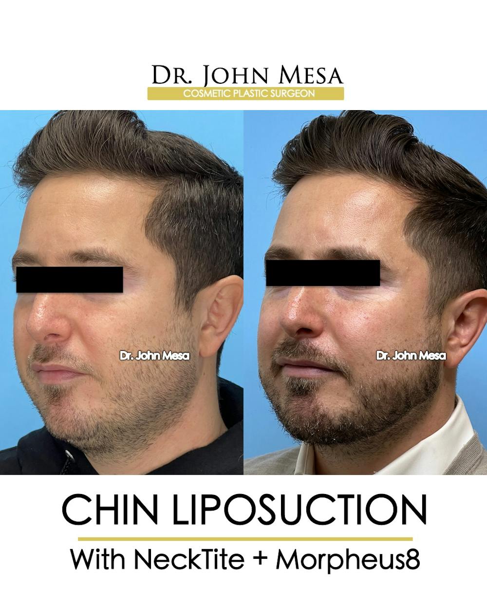 Chin Liposuction Before & After Gallery - Patient 149097987 - Image 4