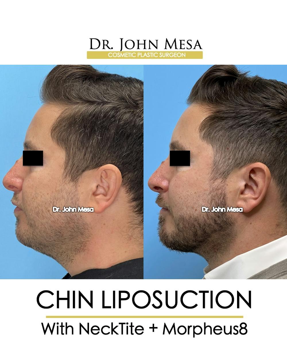 Chin Liposuction Before & After Gallery - Patient 149097987 - Image 5