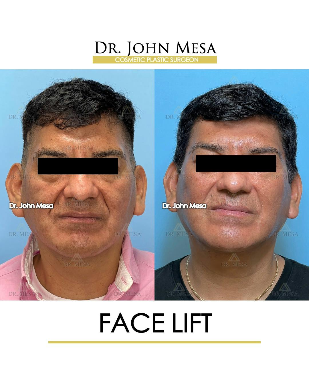 Facelift Before & After Gallery - Patient 149097989 - Image 1
