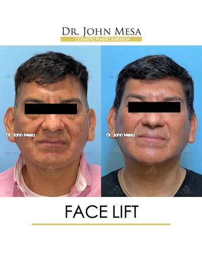 Facelift Before & After Gallery - Patient 149097989 - Image 1