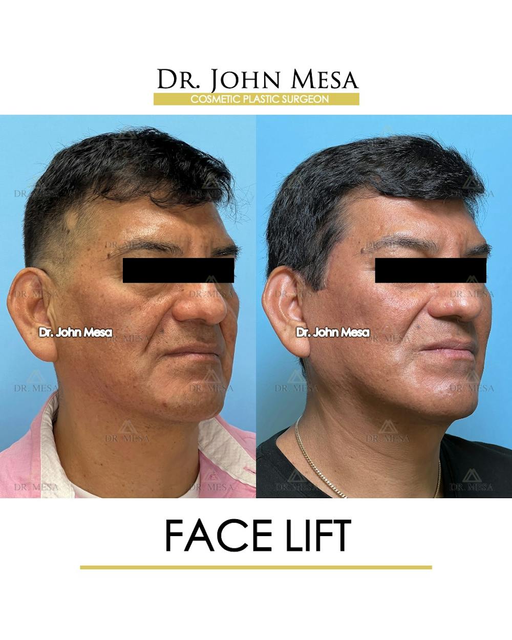 Facelift Before & After Gallery - Patient 149097989 - Image 2