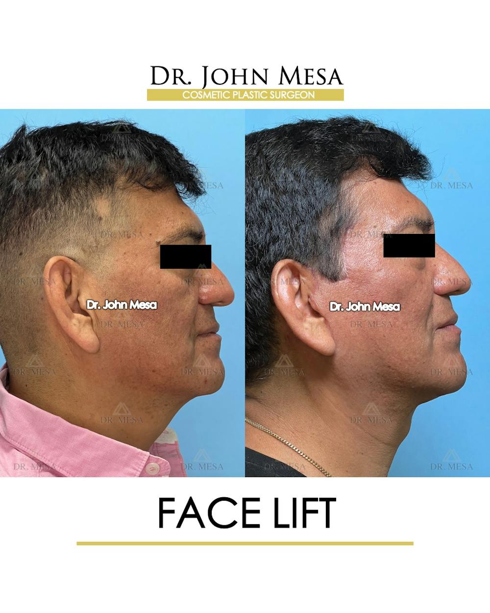 Facelift Before & After Gallery - Patient 149097989 - Image 3