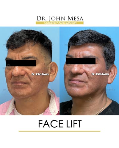 Facelift Before & After Gallery - Patient 149097989 - Image 4