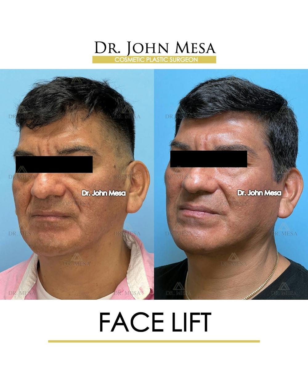 Facelift Before & After Gallery - Patient 149097989 - Image 4