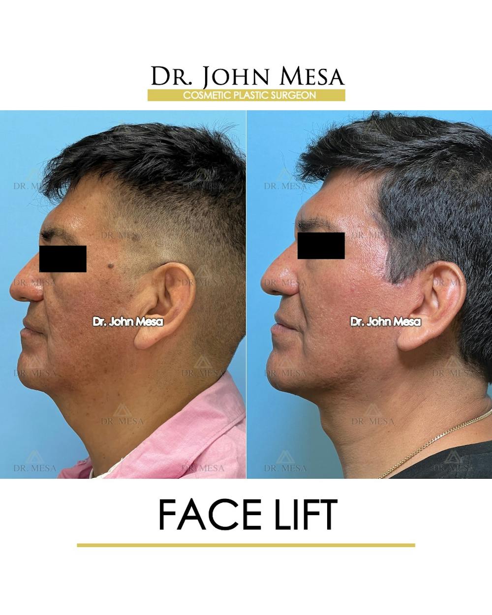 Facelift Before & After Gallery - Patient 149097989 - Image 5