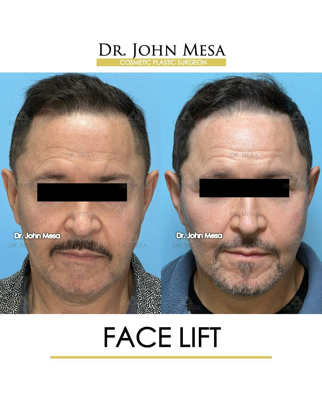 Facelift Before & After Gallery - Patient 149097988 - Image 1