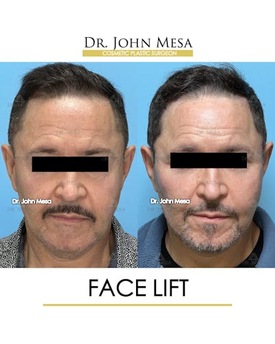 Facelift Before & After Gallery - Patient 149097988 - Image 1