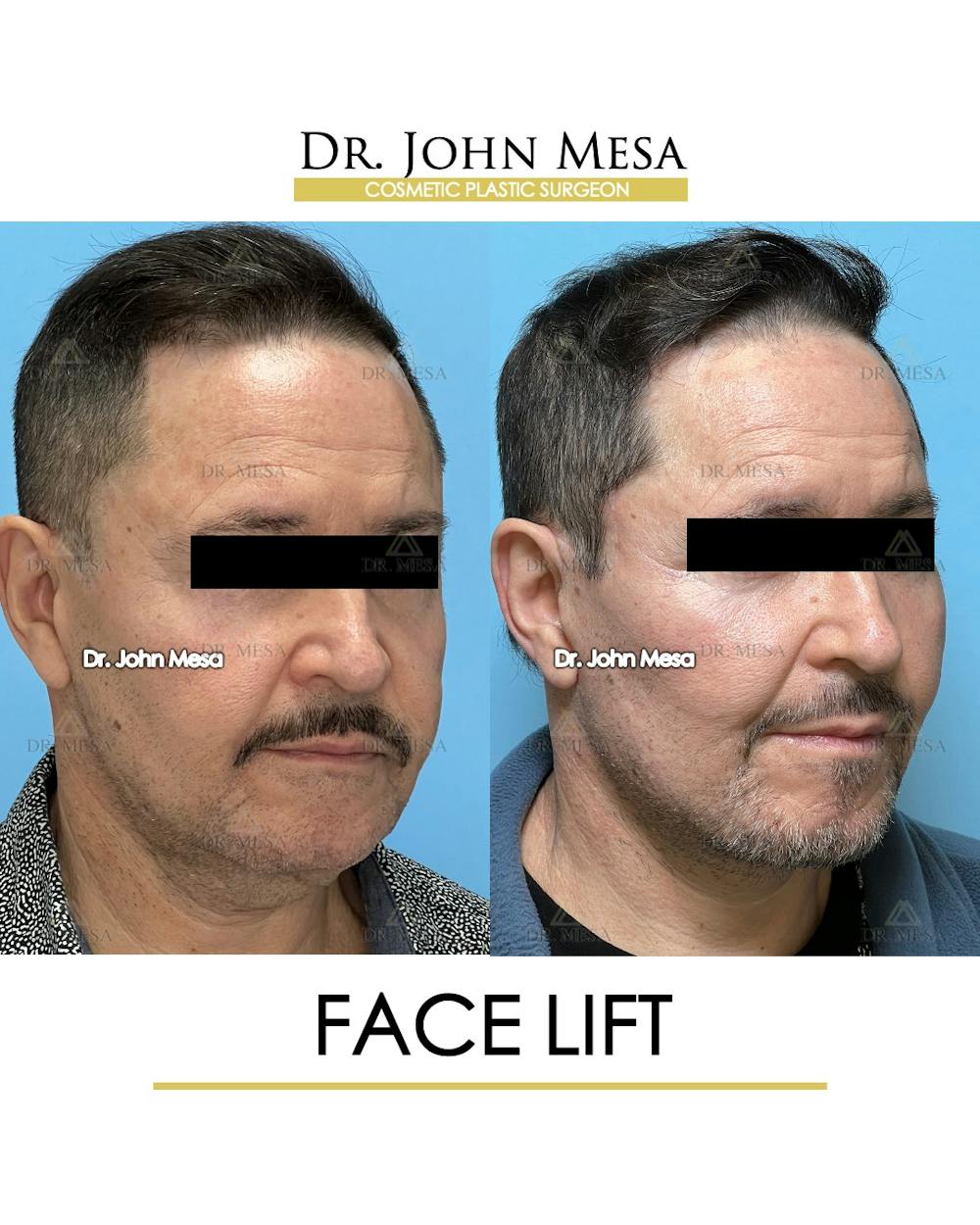 Facelift Before & After Gallery - Patient 149097988 - Image 2