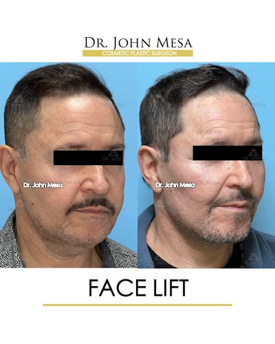 Facelift Before & After Gallery - Patient 149097988 - Image 2