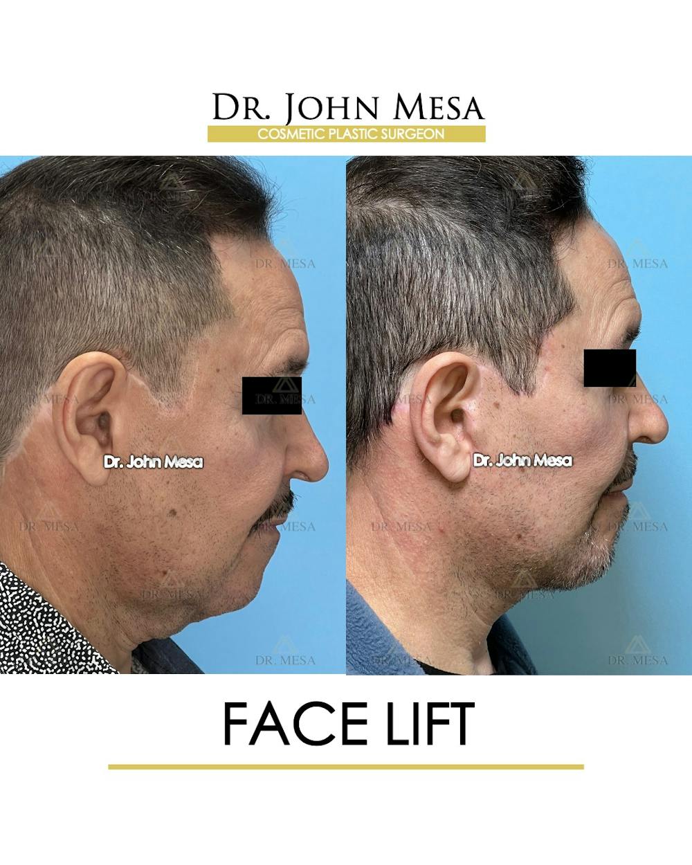 Facelift Before & After Gallery - Patient 149097988 - Image 3