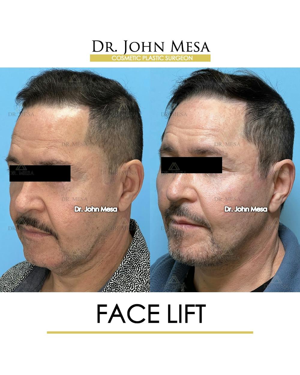 Facelift Before & After Gallery - Patient 149097988 - Image 4