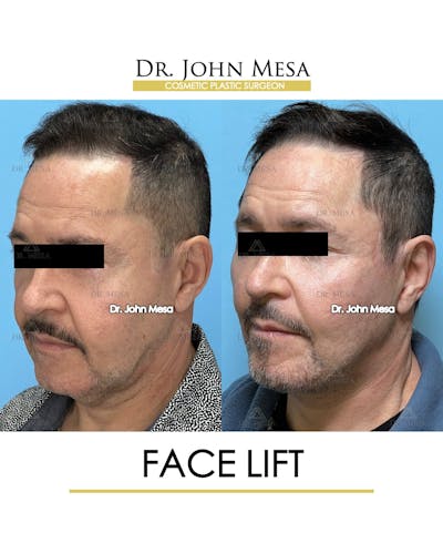Facelift Before & After Gallery - Patient 149097988 - Image 4