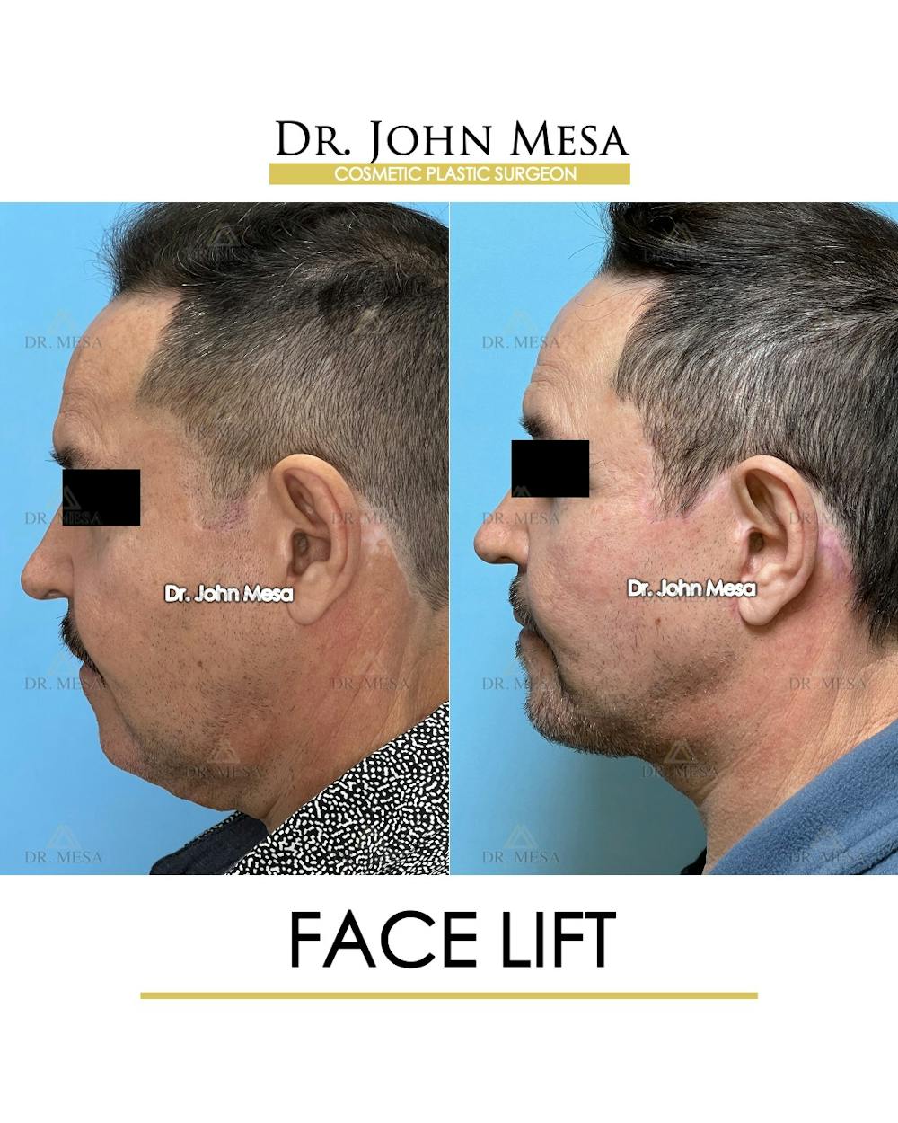Facelift Before & After Gallery - Patient 149097988 - Image 5